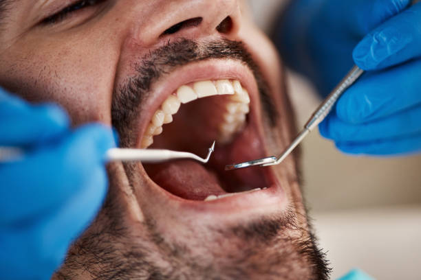 Best Emergency Tooth Extraction in Oronoco, MN